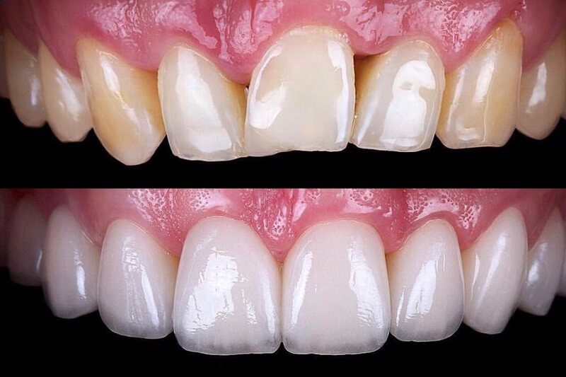 Hollywood smile